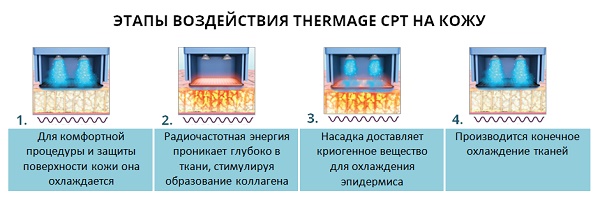 Thermage facial - quelle est cette procédure, comment est-elle effectuée, quelle est la différence avec le levage RF. Photos, résultats, prix, avis