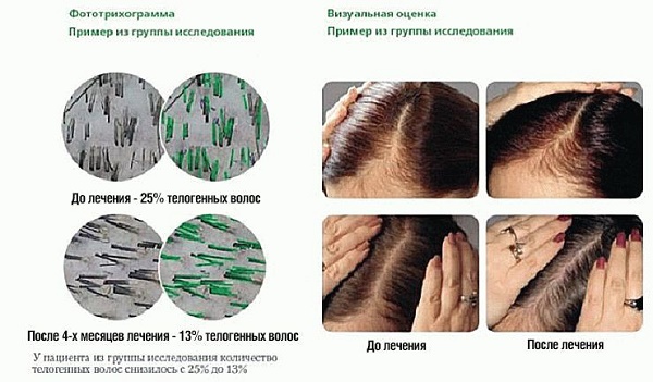 Vitamines pour la chute et la croissance des cheveux. Évaluation des meilleurs de la pharmacie: médicaments efficaces et peu coûteux