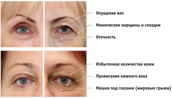 Blépharoplastie. Photos après la chirurgie par jour. Complications, récupération après circulaire, inférieure, supérieure. Rééducation, conséquences