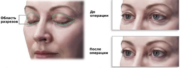 Blépharoplastie. Photos après la chirurgie par jour. Complications, récupération après circulaire, inférieure, supérieure. Rééducation, conséquences