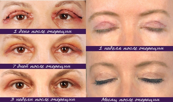 Blépharoplastie. Photos après la chirurgie par jour. Complications, récupération après circulaire, inférieure, supérieure. Rééducation, conséquences