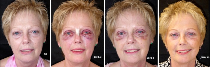 Blépharoplastie. Photos après la chirurgie par jour. Complications, récupération après circulaire, inférieure, supérieure. Rééducation, conséquences