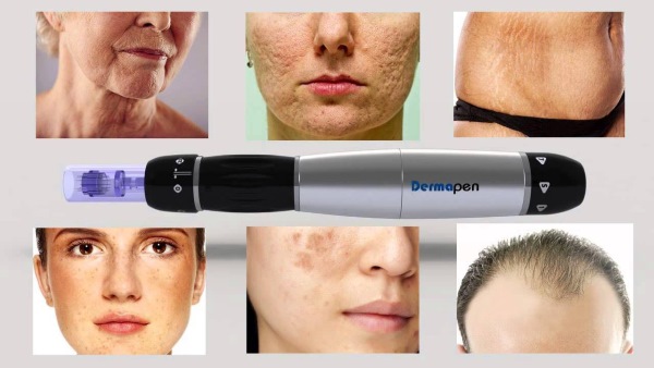 Dermapen: examen de la procédure avec un appareil de remplissage pour la mésothérapie fractionnée. Où acheter, comment utiliser