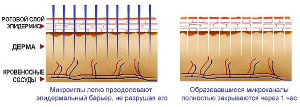 Dermapen: examen de la procédure avec un appareil de remplissage pour la mésothérapie fractionnée. Où acheter, comment utiliser