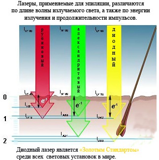 Épilation au laser à diode. Appareil pour la procédure, la préparation, le fonctionnement du laser. Avis, photos avant et après