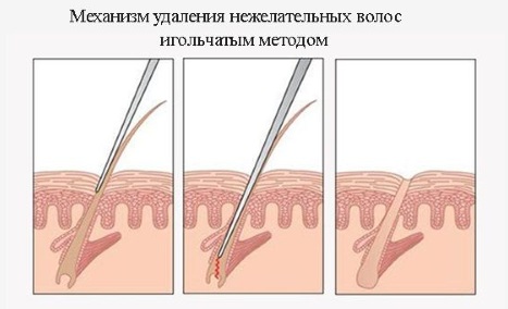 Electrolyse: revues et efficacité, conséquences. Comment est-ce fait sur le visage, le corps, la zone du bikini, les aisselles