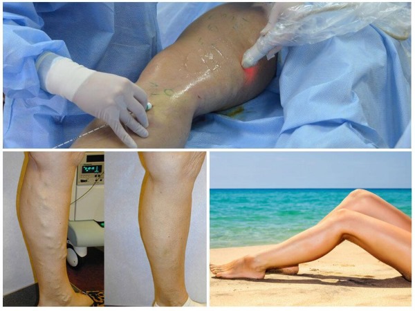 Ablation laser des veines des jambes avec varices. Comment se déroule l'opération, la période postopératoire, la rééducation, les conséquences, les complications