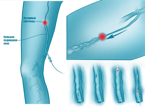 Ablation laser des veines des jambes avec varices. Comment se déroule l'opération, la période postopératoire, la rééducation, les conséquences, les complications