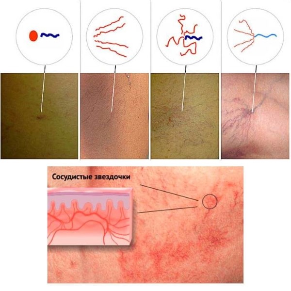 Ablation laser des veines des jambes avec varices. Comment se déroule l'opération, la période postopératoire, la rééducation, les conséquences, les complications