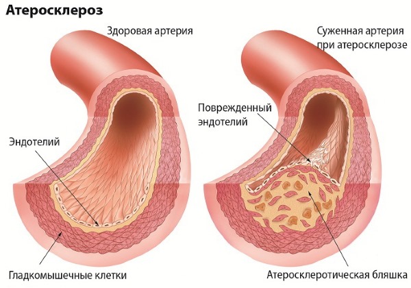 Ablation laser des veines des jambes avec varices. Comment se déroule l'opération, la période postopératoire, la rééducation, les conséquences, les complications