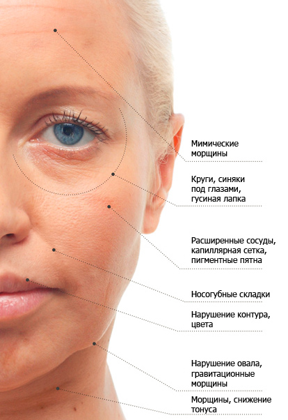 Levage du fil du visage, des paupières, du cou, des sourcils, des seins, de l'abdomen, du front, des fesses. Avantages et inconvénients, comment ils font, le patient examine la réadaptation