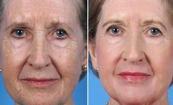 Chirurgie plastique faciale. Photos avant et après la chirurgie de contouring à l'acide hyaluronique. Prix, avis