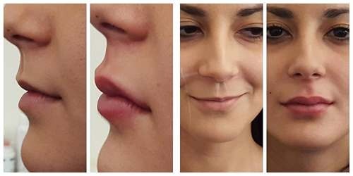 Chirurgie plastique faciale. Photos avant et après la chirurgie de contouring à l'acide hyaluronique. Prix, avis