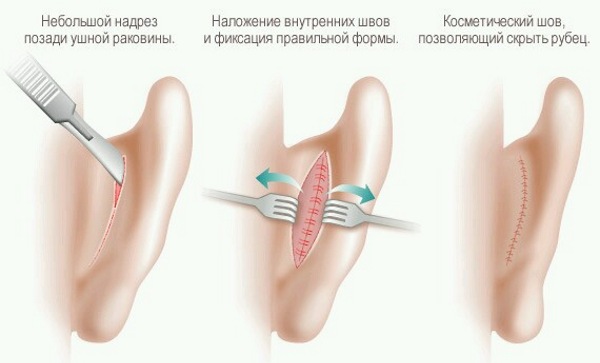 Chirurgie plastique faciale. Photos avant et après la chirurgie de contouring à l'acide hyaluronique. Prix, avis