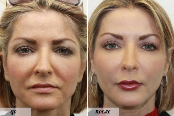 Chirurgie plastique faciale. Photos avant et après la chirurgie de contouring à l'acide hyaluronique. Prix, avis