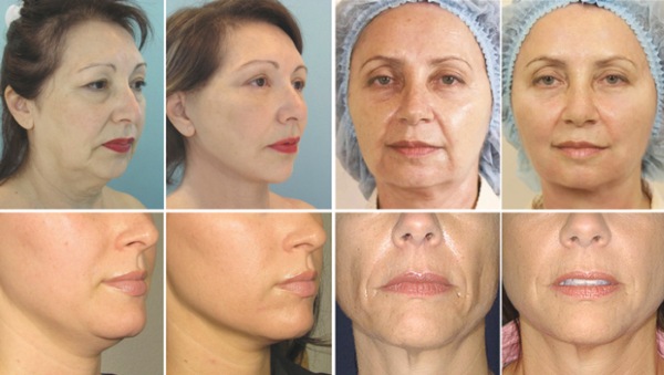 Chirurgie plastique faciale. Photos avant et après la chirurgie de contouring à l'acide hyaluronique. Prix, avis