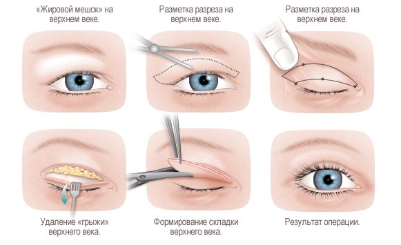 Chirurgie plastique faciale. Photos avant et après la chirurgie de contouring à l'acide hyaluronique. Prix, avis