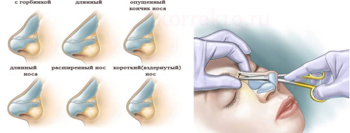 Chirurgie plastique faciale. Photos avant et après la chirurgie de contouring à l'acide hyaluronique. Prix, avis