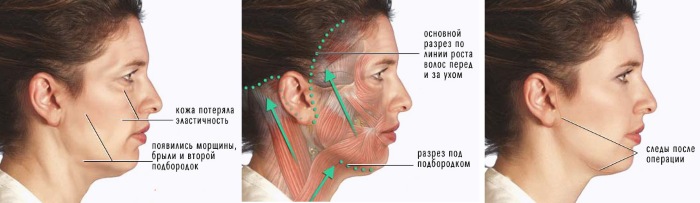 Chirurgie plastique faciale. Photos avant et après la chirurgie de contouring à l'acide hyaluronique. Prix, avis