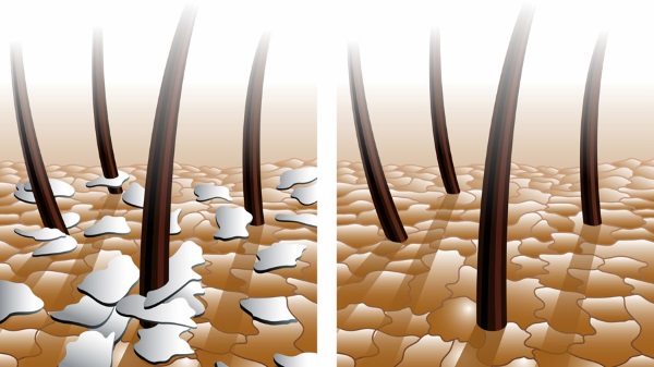 Shampooing antipelliculaire Aleran. Instructions d'utilisation, composition, propriétés médicinales, avis de trichologues