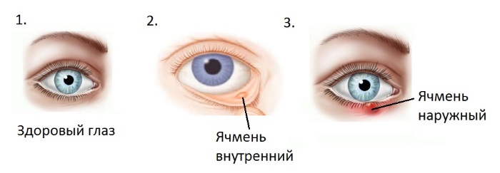 Blefarogel 2. Mode d'emploi, comment appliquer pour l'orge, pour le visage, les paupières, la croissance des cils, pour le gonflement sous les yeux. Analogues