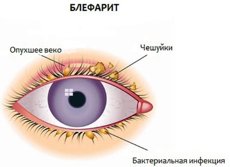 Blefarogel 2. Mode d'emploi, comment appliquer pour l'orge, pour le visage, les paupières, la croissance des cils, pour le gonflement sous les yeux.Analogues