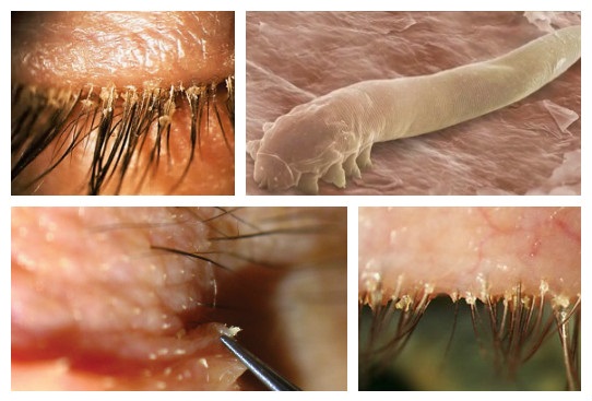 Blefarogel 2. Mode d'emploi, comment appliquer pour l'orge, pour le visage, les paupières, la croissance des cils, pour le gonflement sous les yeux. Analogues