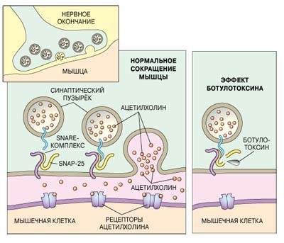 Thérapie botulique en cosmétologie - qu'est-ce que c'est, efficacité et résultats, critiques. Dysport, Xeomin, Botox