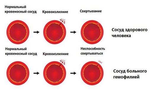 Thérapie botulique en cosmétologie - qu'est-ce que c'est, efficacité et résultats, critiques. Dysport, Xeomin, Botox