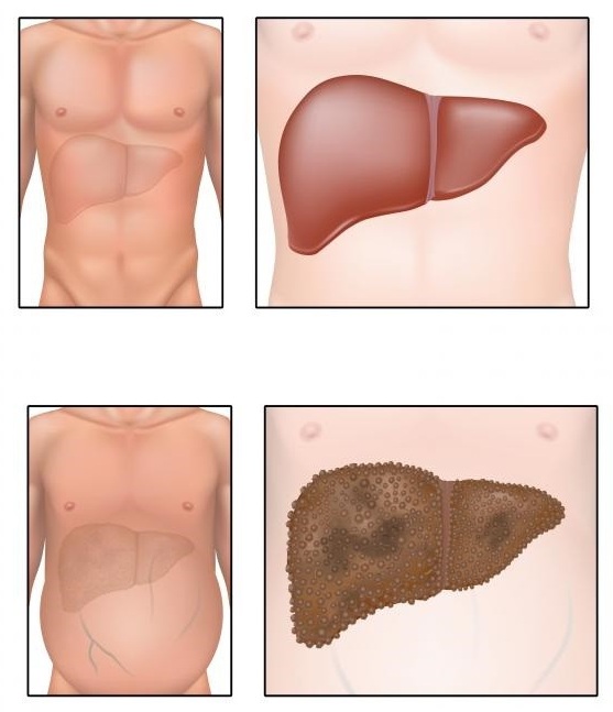 Comment prendre des pilules de furosémide pour perdre du poids. Mode d'emploi, indications, action