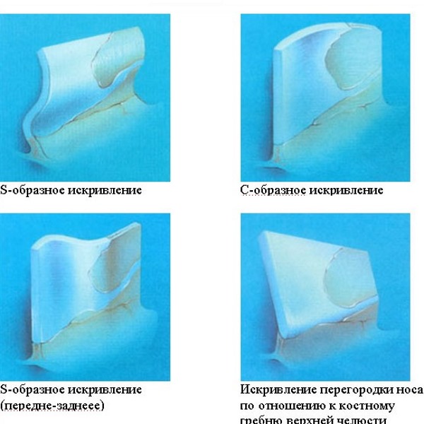 Courbure de la cloison nasale. Symptômes, causes et conséquences. Opération de septoplastie: indications, contre-indications, types et caractéristiques