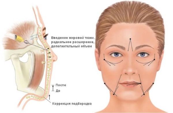 Comment éliminer les plis nasogéniens: charges, acide hyaluronique, correction des contours, botox et lipofilling, exercices du visage