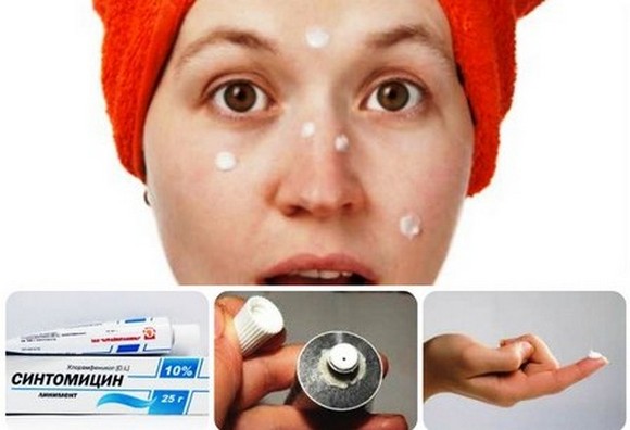 Pommades pour l'acné sur le visage: peu coûteuses et efficaces avec un antibiotique, pour les rouges, points noirs, acné, marques, pour les adolescents Noms et prix