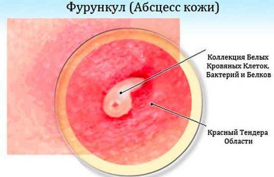 Pommades pour l'acné sur le visage: peu coûteuses et efficaces avec un antibiotique, pour les rouges, points noirs, acné, marques, pour les adolescents Noms et prix