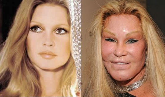 Top 10 des stars de la chirurgie plastique qui n'ont pas réussi. Photos avant et après les acteurs soviétiques, russes, étrangers, hollywoodiens