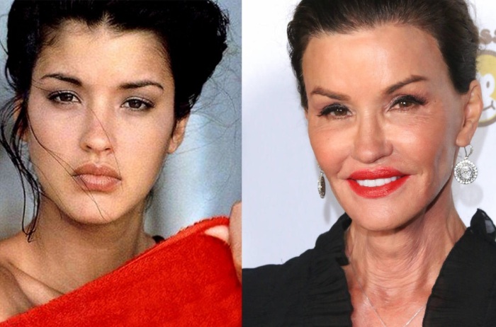 Top 10 des stars de la chirurgie plastique qui n'ont pas réussi. Photos avant et après les acteurs soviétiques, russes, étrangers, hollywoodiens