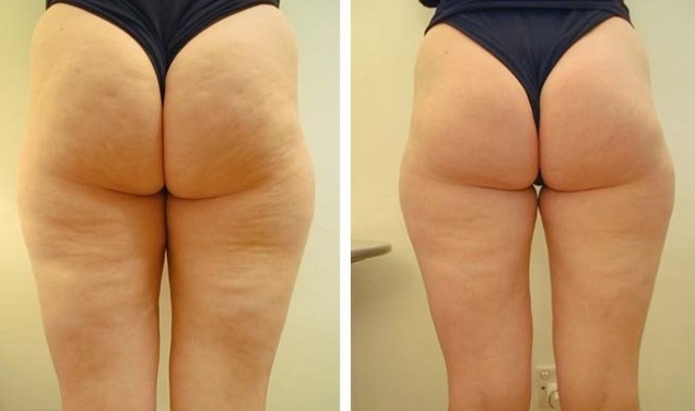 Enveloppement cellulite à la crème Capsicam sur les cuisses, les fesses, l'abdomen. Recettes maison efficaces