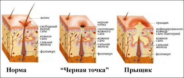 Nettoyez votre visage à la maison. Comment faire des points noirs, de l'acné, des remèdes populaires. Recettes pour masques et gommages, appareils à usage domestique