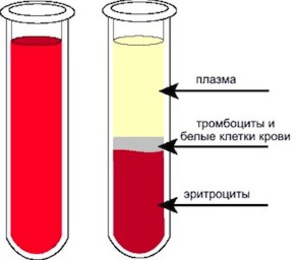 Plasmaphorèse - indications d'utilisation en gynécologie, grossesse, allergies, psoriasis. Effets secondaires possibles, coût de la procédure