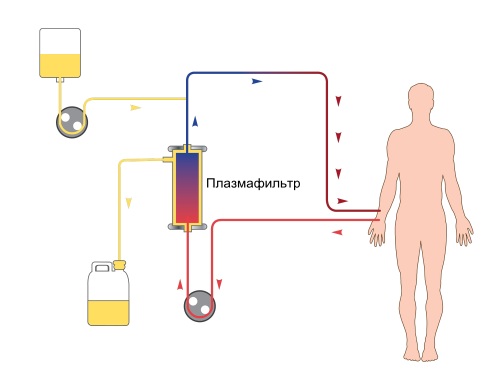 Plasmaphorèse - indications d'utilisation en gynécologie, grossesse, allergies, psoriasis. Effets secondaires possibles, coût de la procédure