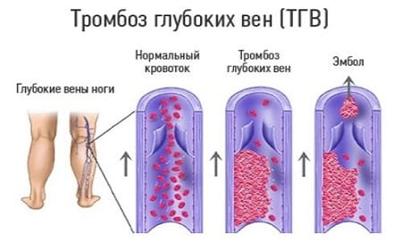 Plasmaphorèse - indications d'utilisation en gynécologie, grossesse, allergies, psoriasis. Effets secondaires possibles, coût de la procédure