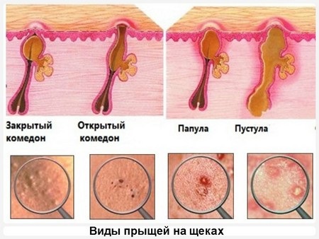 Boutons sur les joues. Les raisons pour lesquelles les femmes, quel organe n'est pas en ordre, pourquoi il apparaît. Traitement à domicile