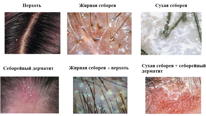 Acide salicylique pour l'acné. Comment l'utiliser pour ne pas provoquer de brûlure, aide-t-il dans les pilules, une prescription pour bavarder avec du chloramphénicol. Indications et contre-indications