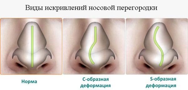 Septoplastie de la cloison nasale.Quelle est cette onde radio laser, endoscopique. Période postopératoire, conséquences