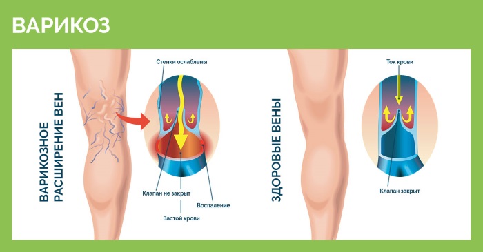 Sclérothérapie des veines des jambes - quelle est cette procédure, la période de rééducation, les complications possibles et les conséquences