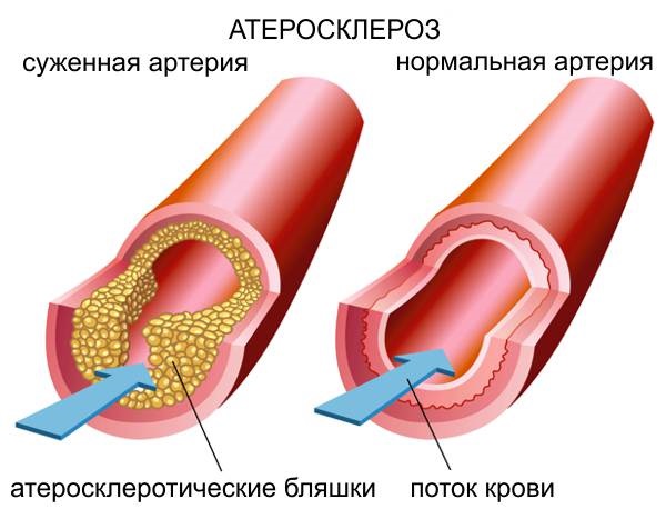 Sclérothérapie des veines des jambes - quelle est cette procédure, la période de rééducation, les complications possibles et les conséquences