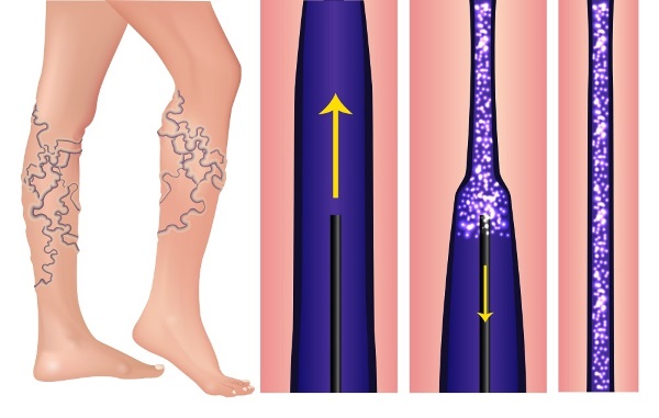 Sclérothérapie des veines des jambes - quelle est cette procédure, la période de rééducation, les complications possibles et les conséquences