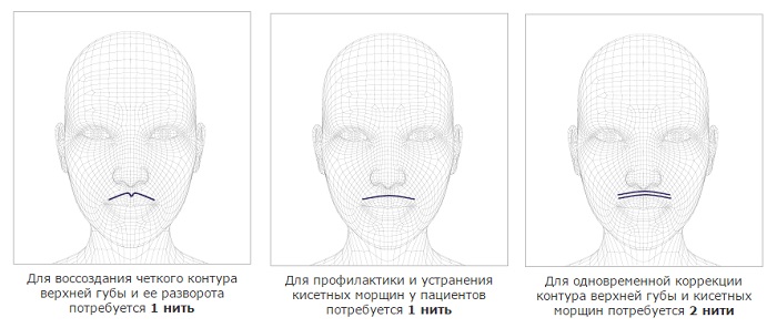 Augmentation des lèvres avec de l'acide hyaluronique, des charges, du botox, du silicone, des plastiques de contour. Photo, prix, avis