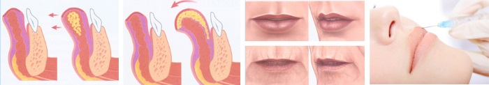 Augmentation des lèvres avec de l'acide hyaluronique, des charges, du botox, du silicone, des plastiques de contour. Photo, prix, avis