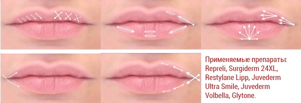 Augmentation des lèvres avec de l'acide hyaluronique, des charges, du botox, du silicone, des plastiques de contour. Photo, prix, avis